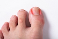 The Stages of Ingrown Toenails