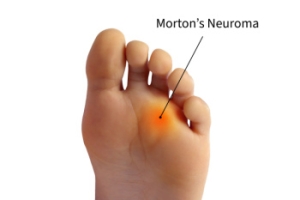 Signs of Morton’s Neuroma