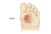 Diabetic Foot Ulcers and Podiatric Care