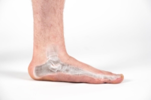 Genetic Causes of Flat Feet