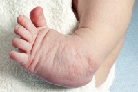 Developmental Foot Problems in Newborns