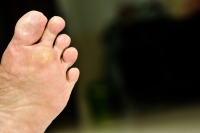 Unwanted Visitors on Your Feet